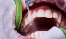 جرم‌گیری، راهی موثر برای پیشگیری از پوسیدگی و بیماری لثه