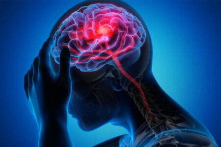 تحریک نخاع به بازیابی قدرت بازو پس از سکته مغزی کمک می کند